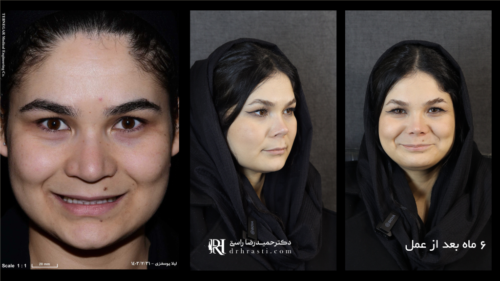 عمل بینی چند درصد در زیبایی تأثیر دارد