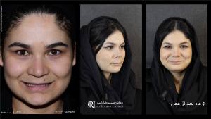 عمل بینی چند درصد در زیبایی تأثیر دارد