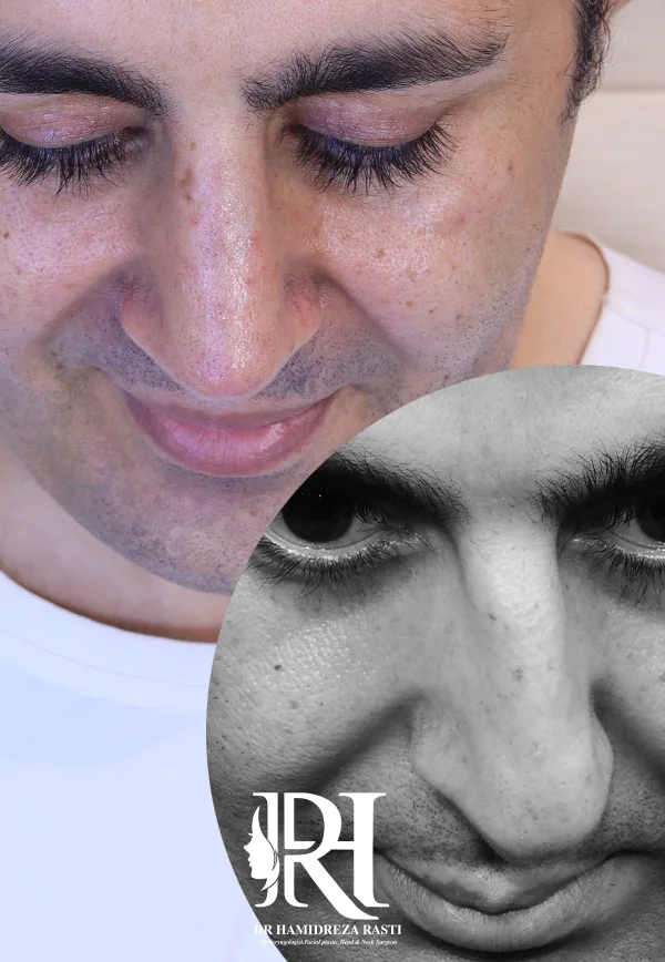 انحراف شدید بینی