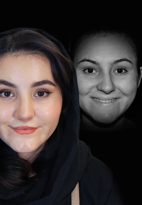 جراحی بینی کج