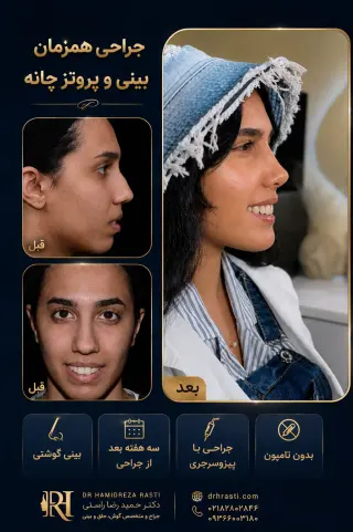 Before and after combined rhinoplasty and chin implant surgery