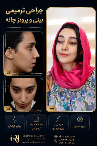 Before and after revision rhinoplasty and chin implant