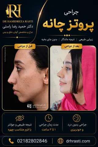 Before and after chin implant with a natural result