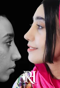 Tarmimi جراحی بینی ترمیمی