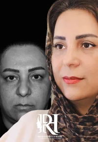 belfaro بلفاروپلاستی