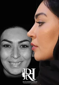 جراحی بینی گوشتی