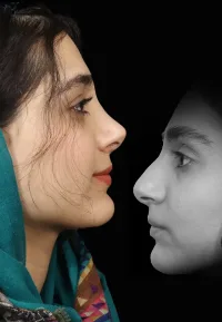 جراحی بینی استخوانی