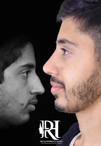 جراحی بینی مردانه