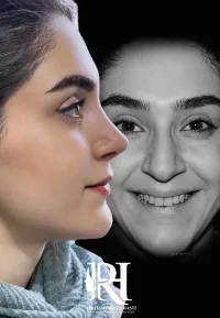 جراحی بینی طبیعی