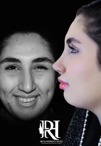 جراحی بینی نیمه فانتزی